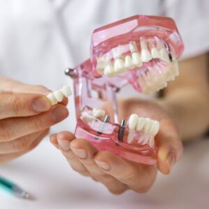 Dental implants
