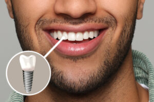 dental implants port richey dental clinic port richey dentist in port richey